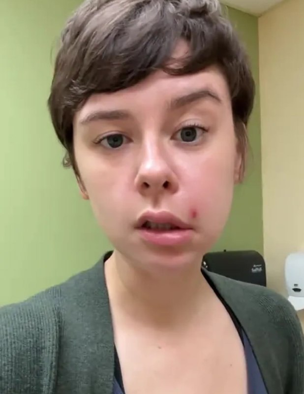 Дівчина видавила прищ і у неї «перекосило» обличчя, – The Sun Ліндсі де Олівейра...